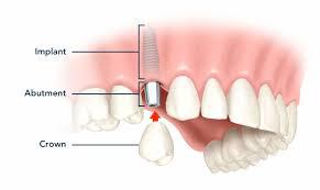 Image of Single Dental Implant