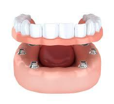 Image of Implant Supported Dentures
